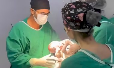 Gêmeos siameses de MT passam por cirurgia de separação de emergência em Goiânia após um deles morrer