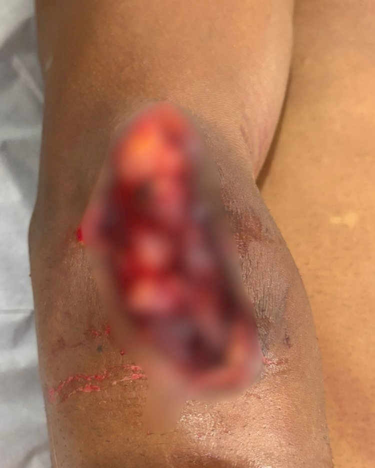 Trabalhador é atacado por pitbull durante coleta de lixo em Canarana